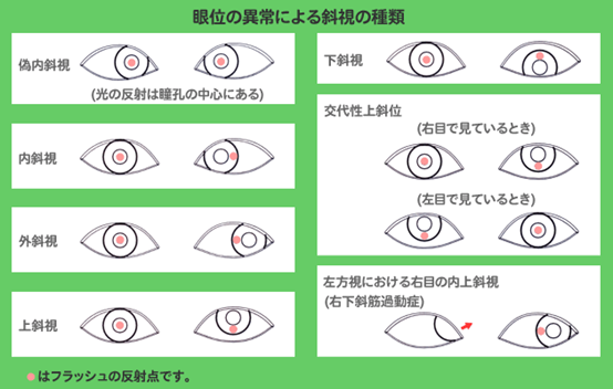 俗稱脫窗 眼睛斜位 斜視 你不可不知的事實 億點儷眼鏡 眼鏡看世間 視力 太陽眼鏡 光學眼鏡 精配多焦點 色盲 斜視 痞客邦
