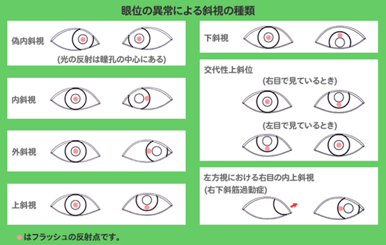 左目 痙攣