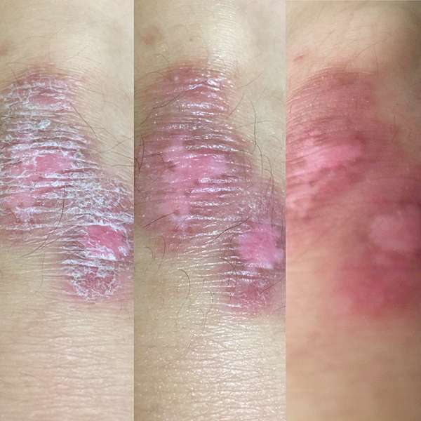 板橋龍昌診所燙傷藥膏外傷也來用看看用法也分享 36號弟弟的保養品配方收藏 痞客邦