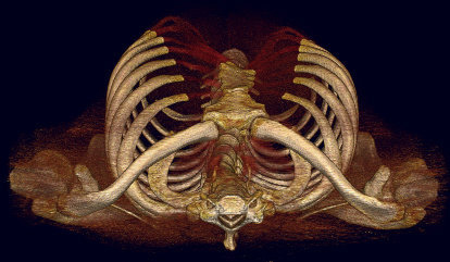 用三度空間電腦斷層可看出變形肋骨及肋軟骨