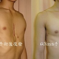 漏斗胸--Nuss手術亦可用於治療傳統手術失敗的病例