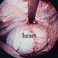 Nuss手術中以胸腔鏡目視下操作, 安全性高, 圖中心肺均未受矯正板影響