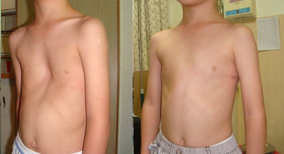 五歲男童的典型凹胸矯治前後比較