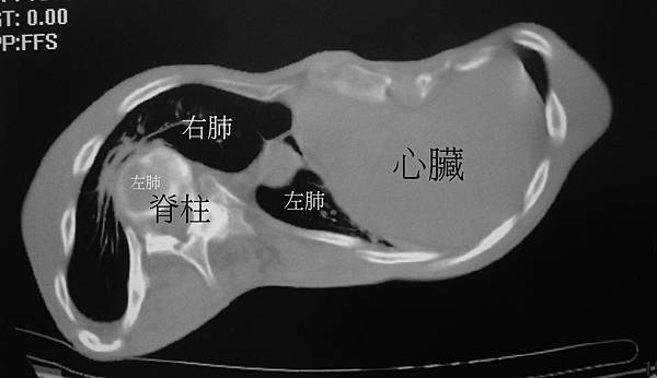 十分嚴重的凹胸合併脊柱側曲.