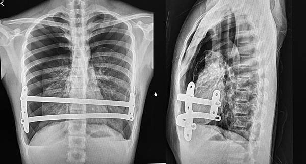 pneumothorax-after-Nuss.jpg