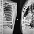 pneumothorax-after-Nuss.jpg
