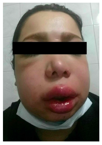 Lip Silicone_01.png Lip Silicone_01.png