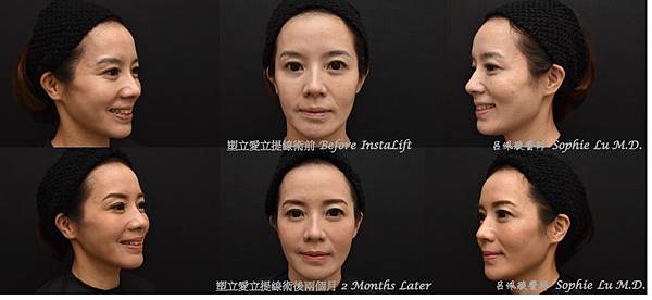 InstaLift Model.jpg InstaLift Model.jpg