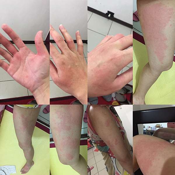 人體大實驗 蕁麻疹 不用怕 照吃 照抹 沒再發作過 蔡沛沛的瘋狂生活 痞客邦