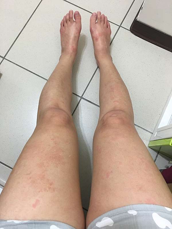 人體大實驗 蕁麻疹 不用怕 照吃 照抹 沒再發作過 蔡沛沛的瘋狂生活 痞客邦