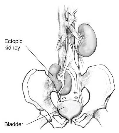 異位腎