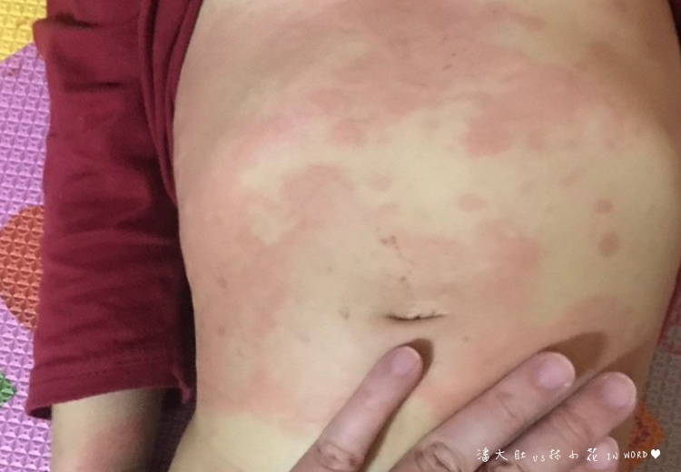 蕁麻疹4 蕁麻疹4