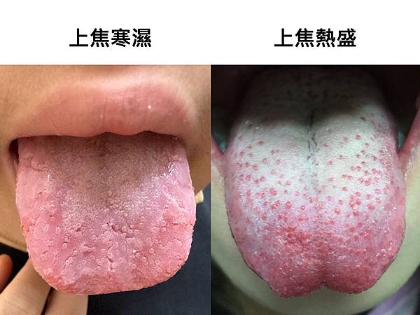 三伏貼與小兒鼻過敏舌診