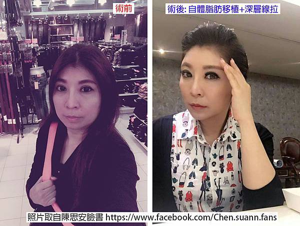 自體脂肪移植 深層線拉 陳思安 謝東穎整形外科 自體脂肪移植 深層線拉 陳思安 謝東穎整形外科