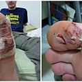 the hurt toe .jpg