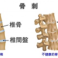 骨刺.jpg