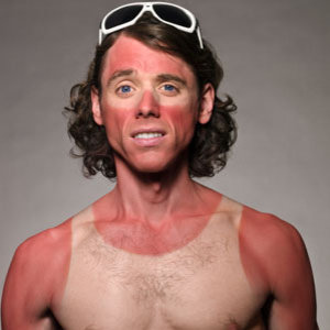 sunburn-medium_new.jpg