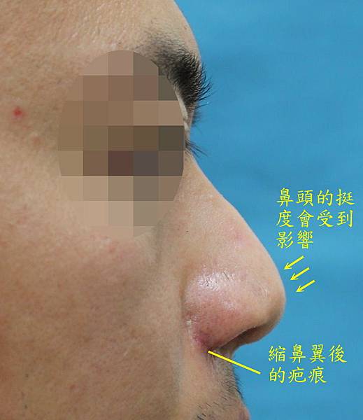 縮鼻翼手術，做或不做 Alar reduction, to 