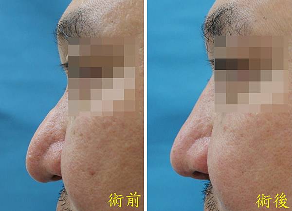 用自體軟骨重建鼻型 Using autologous car