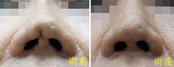 鼻尖皮膚的重修 nasal tip skin defect 