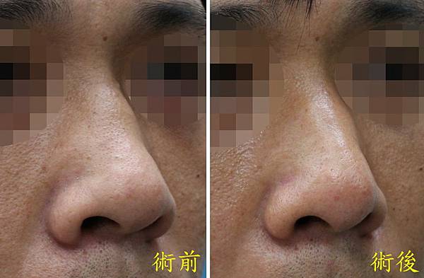 利用耳軟骨矯正鼻部中段缺陷 Using ear cartil