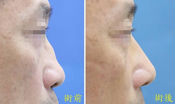 打造一個好呼吸的鼻型  To create a well-f