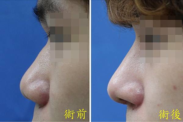 鼻型延長 Lengthen the nasal dorsum