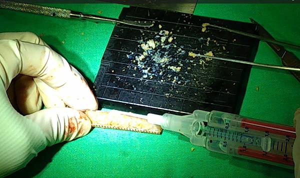 以組織膠膠合碎軟骨 diced cartilage + ti