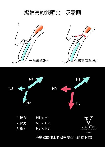 Higher crease示意圖.jpg Higher crease示意圖.jpg