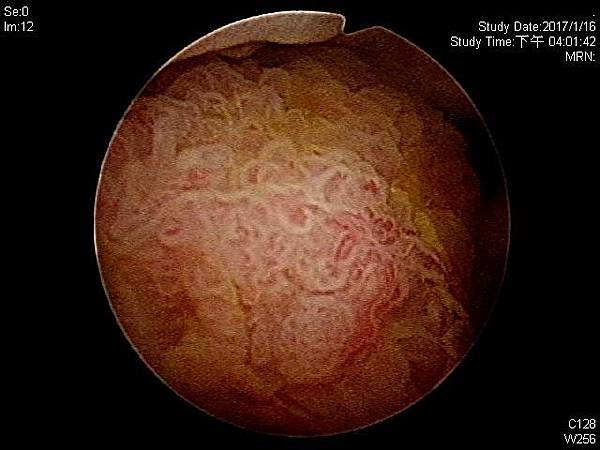 urinary bladder cancer1.jpg