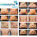 冷凍溶脂Coolsculpting.gif