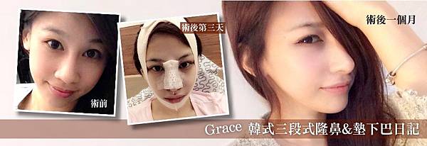 Grace韓式三段式隆鼻墊下巴整形日記 附圖 三段式隆鼻心得經驗分享文 術前術後照片差異驚人 韓式三段式隆鼻權威醫師醫生推薦價格費用價錢價位 Grace韓式三段式隆鼻墊下巴整形日記 附圖 三段式隆鼻心得經驗分享文 術前術後照片差異驚人 韓式三段式隆鼻權威醫師醫生推薦價格費用價錢價位