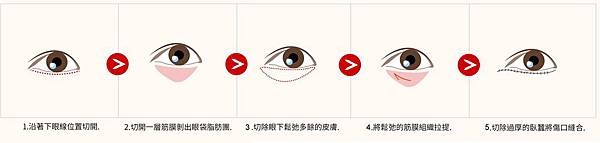 04微創內外開眼袋手術復發眼瞼外翻.jpg 04微創內外開眼袋手術復發眼瞼外翻.jpg