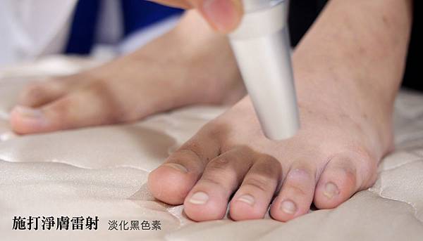 04.施打淨膚雷射淡化腳趾頭黑色素.jpg 04.施打淨膚雷射淡化腳趾頭黑色素.jpg