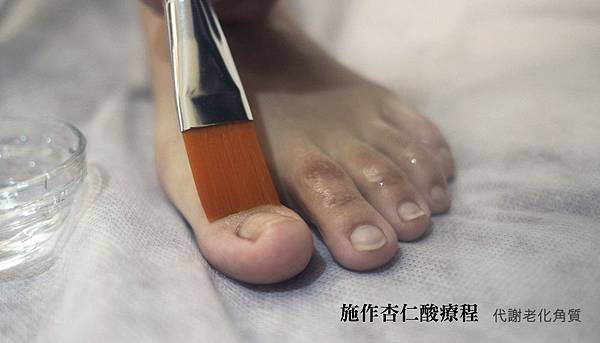 03.施作杏仁酸療程代謝角質.jpg 03.施作杏仁酸療程代謝角質.jpg