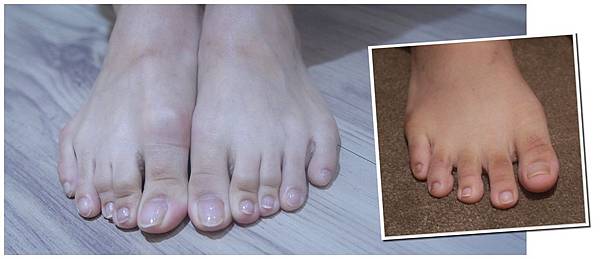 07.腳趾頭黑黑治療後前後比對 07.腳趾頭黑黑治療後前後比對