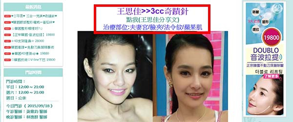 王思佳疑似隆鼻隆乳割雙眼皮整形? 王思佳疑似隆鼻隆乳割雙眼皮整形?