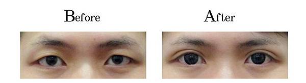 吳孟穎醫師開放式割雙眼皮案例-自然形大寬度雙眼皮.jpg 吳孟穎醫師開放式割雙眼皮案例-自然形大寬度雙眼皮.jpg