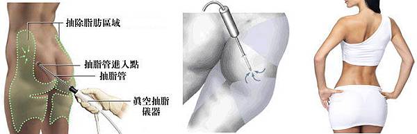 005自體脂肪移植手術部落客PTT討論區.jpg