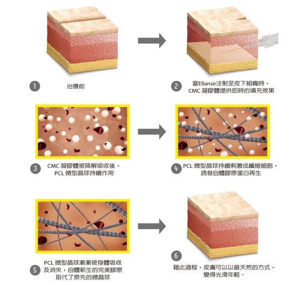 003童顏針按摩失敗效果淚溝術後權威推薦診所童顏針價格價錢價位廠商.jpg