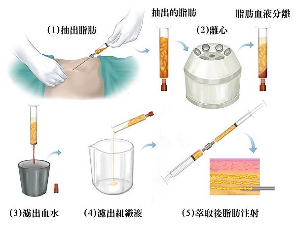 005抽脂手術費用復胖失敗日記英文術後豐胸按摩ptt死亡後遺症副作用硬塊塑身衣.jpg