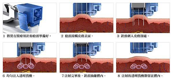 03水光槍針治療凹洞痘疤效果如何.jpg 03水光槍針治療凹洞痘疤效果如何.jpg