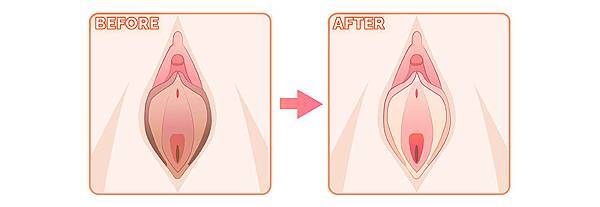 04陰唇顏色改善有什麼方法.jpg