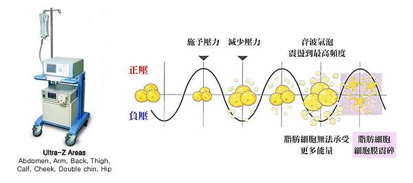 04UltraZ威塑手術臉部手臂腹部臀部大小腿效果.jpg