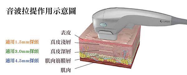 04音波拉提拉提費用價為價錢價格.jpg