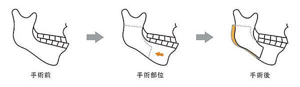 04正顎手術PTT推薦醫師醫生診所.jpg 04正顎手術PTT推薦醫師醫生診所.jpg