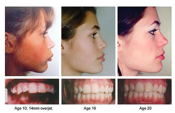 03縮唇修唇手術失敗後遺症風險併發症副作用.jpg 03縮唇修唇手術失敗後遺症風險併發症副作用.jpg