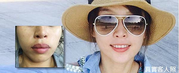 07縮唇手術修嘴唇形狀.jpg 07縮唇手術修嘴唇形狀.jpg