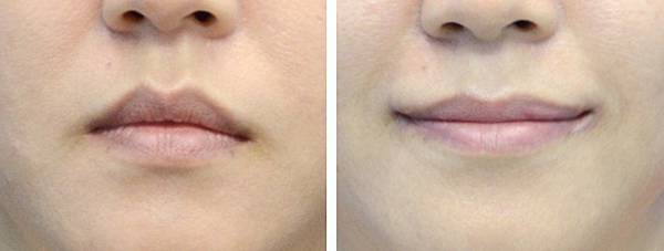 12縮唇修唇手術.jpg 12縮唇修唇手術.jpg