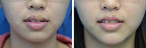 15複合式縮修嘴唇手術.jpg 15複合式縮修嘴唇手術.jpg